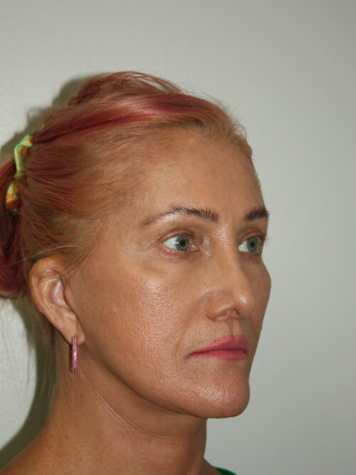 Female Facelift Patient 60 - After - 1