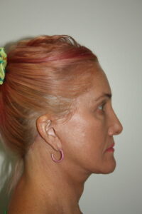 Female Facelift Patient 60 - After - 3 Thumbnail