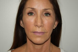 Female Facelift Patient 61 - After - 2 Thumbnail