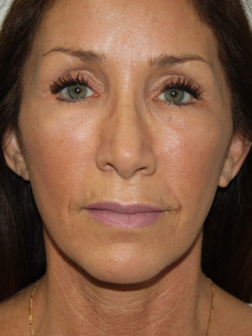 Female Facelift Patient 61 - After - 2