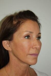 Female Facelift Patient 61 - After - 1 Thumbnail