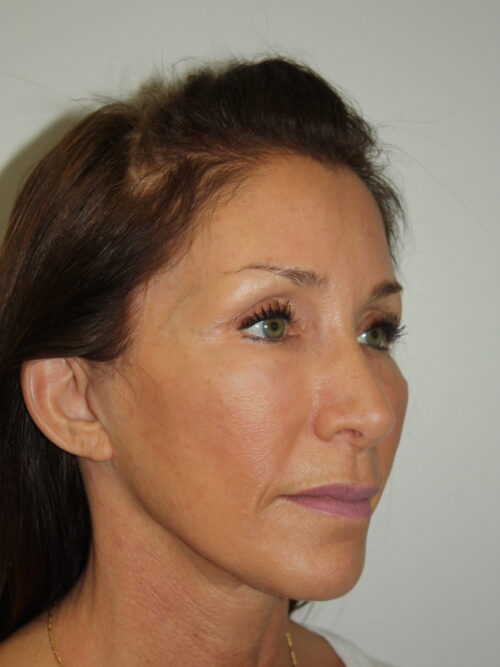 Female Facelift Patient 61 - After - 1