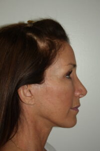 Female Facelift Patient 61 - After - 3 Thumbnail