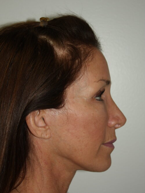 Female Facelift Patient 61 - After - 3