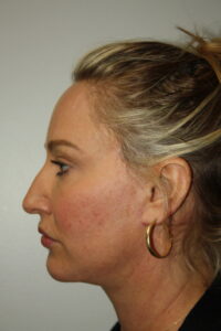 Female Facelift Patient 59 - After - 3 Thumbnail