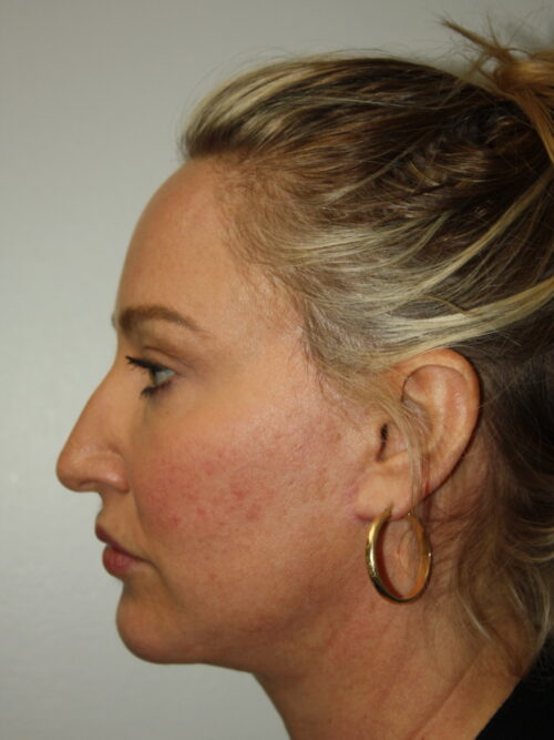 Female Facelift Patient 59 - After - 3