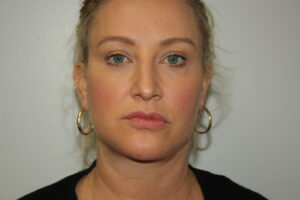 Female Facelift Patient 59 - After - 2 Thumbnail