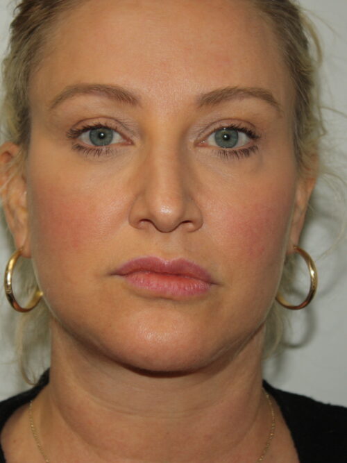 Female Facelift Patient 59 - After - 2