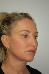 Female Facelift Patient 59 - After - 1 Thumbnail