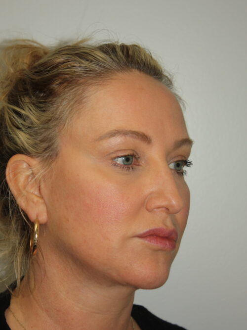 Female Facelift Patient 59 - After - 1