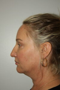 Female Facelift Patient 59 - Before - 3 Thumbnail