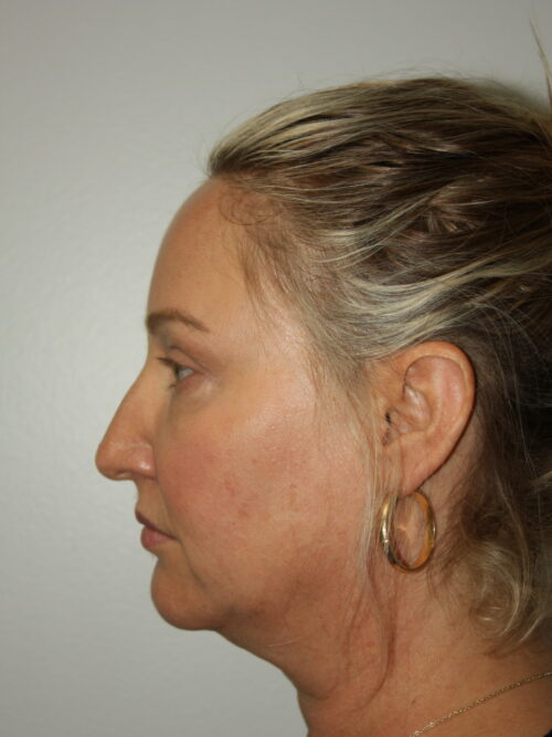 Female Facelift Patient 59 - Before - 3