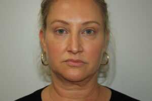 Female Facelift Patient 59 - Before - 2 Thumbnail