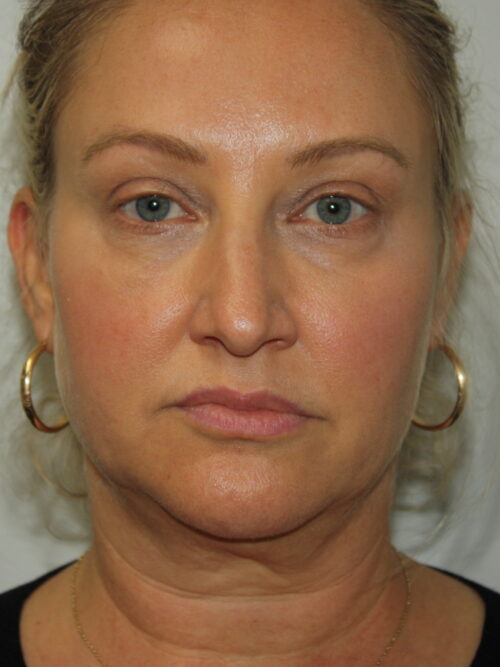 Female Facelift Patient 59 - Before - 2