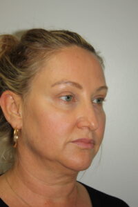 Female Facelift Patient 59 - Before - 1 Thumbnail