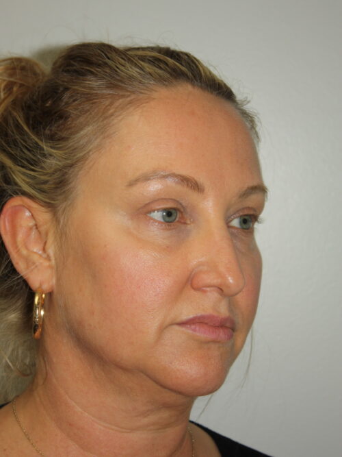 Female Facelift Patient 59 - Before - 1