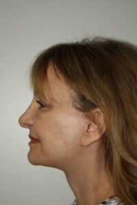 Female Facelift Patient 62 - After - 3 Thumbnail