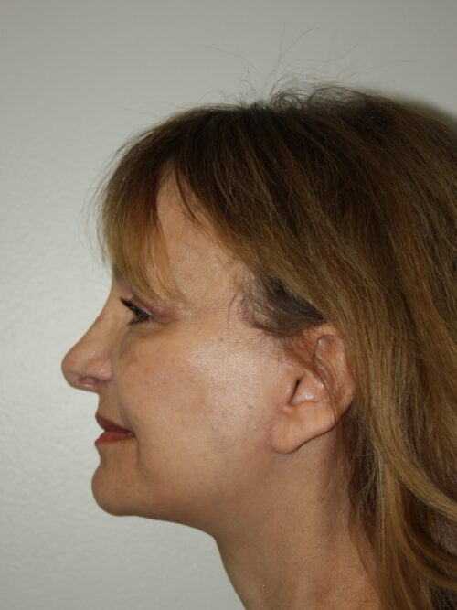 Female Facelift Patient 62 - After - 3