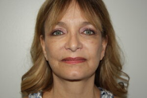 Female Facelift Patient 62 - After - 2 Thumbnail