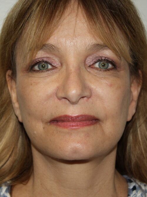 Female Facelift Patient 62 - After - 2