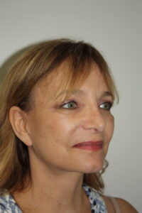 Female Facelift Patient 62 - After - 1 Thumbnail