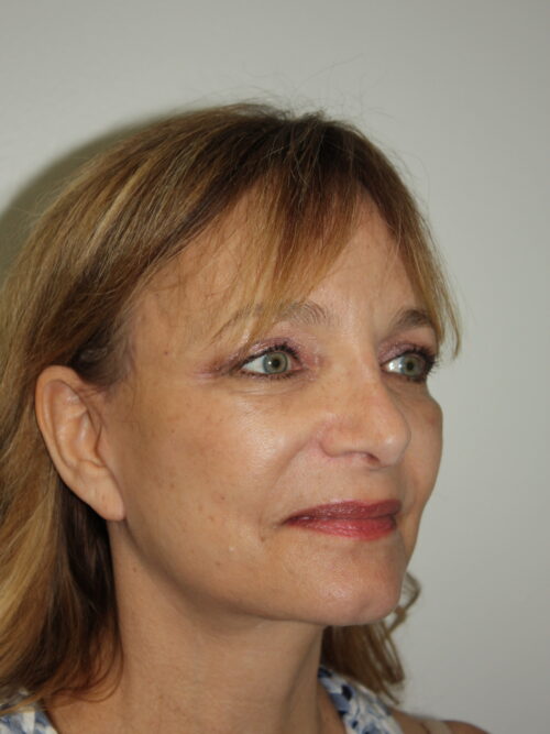 Female Facelift Patient 62 - After - 1