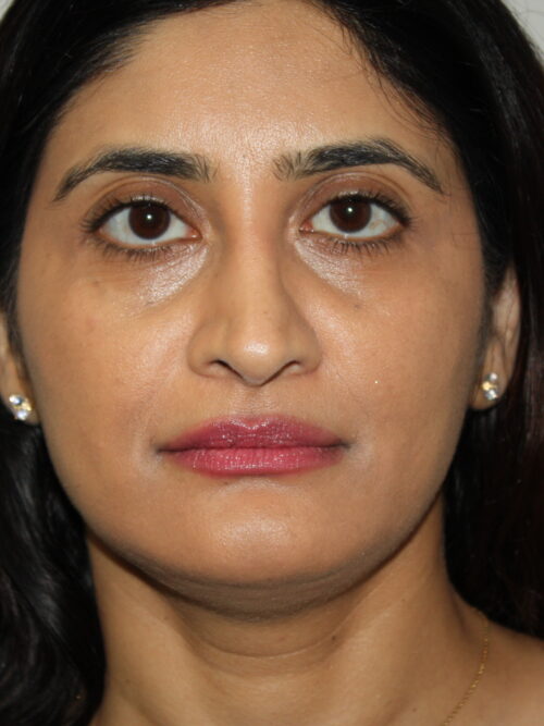 Rhinoplasty Patient 38 - After - 1