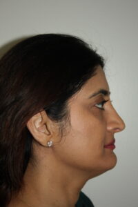 Rhinoplasty Patient 38 - After - 3 Thumbnail