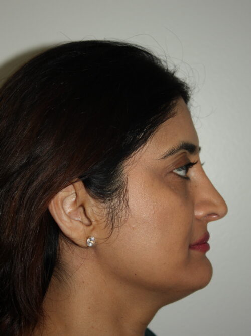 Rhinoplasty Patient 38 - After - 3