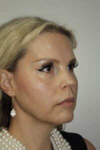 Female Facelift Patient 67 - Before - 1 Thumbnail