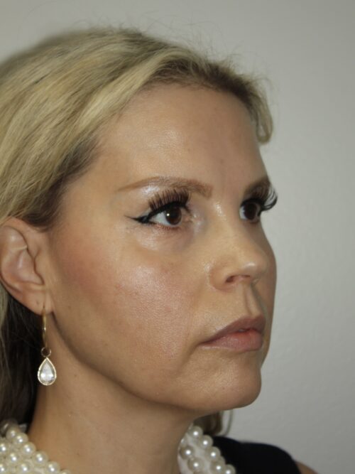 Female Facelift Patient 67 - Before - 1