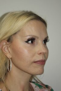 Female Facelift Patient 67 - After - 1 Thumbnail