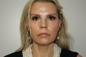 Female Facelift Patient 67 - Before - 2 Thumbnail