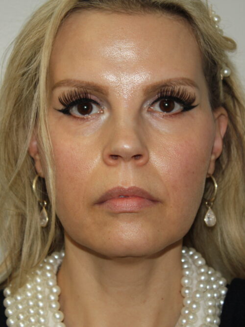 Female Facelift Patient 67 - Before - 2