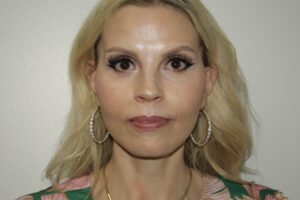 Female Facelift Patient 67 - After - 2 Thumbnail