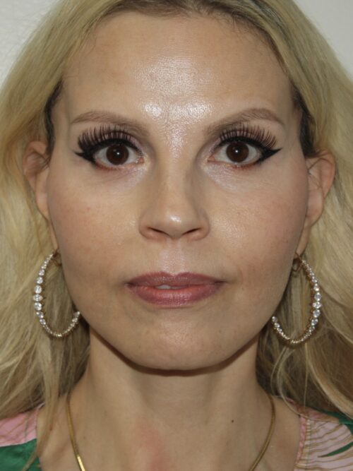 Female Facelift Patient 67 - After - 2