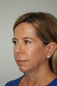 Female Facelift Patient 65 - Before - 1 Thumbnail