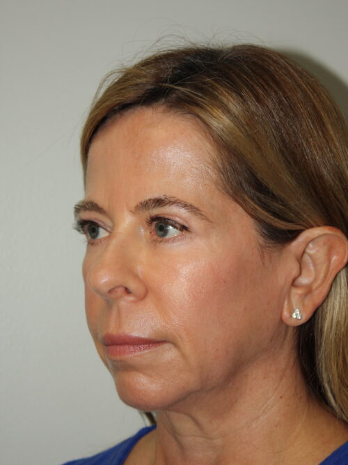 Female Facelift Patient 65 - Before - 1