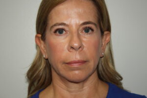 Female Facelift Patient 65 - Before - 2 Thumbnail