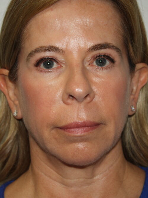 Female Facelift Patient 65 - Before - 2