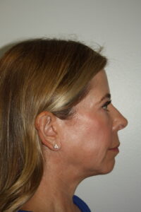 Female Facelift Patient 65 - Before - 3 Thumbnail