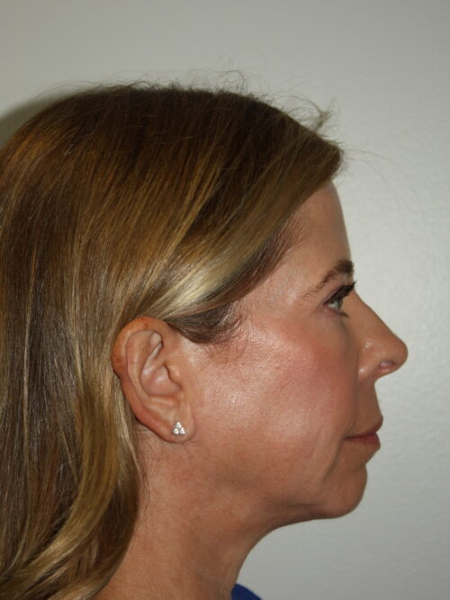 Female Facelift Patient 65 - Before - 3