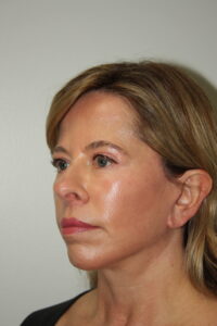 Female Facelift Patient 65 - After - 1 Thumbnail