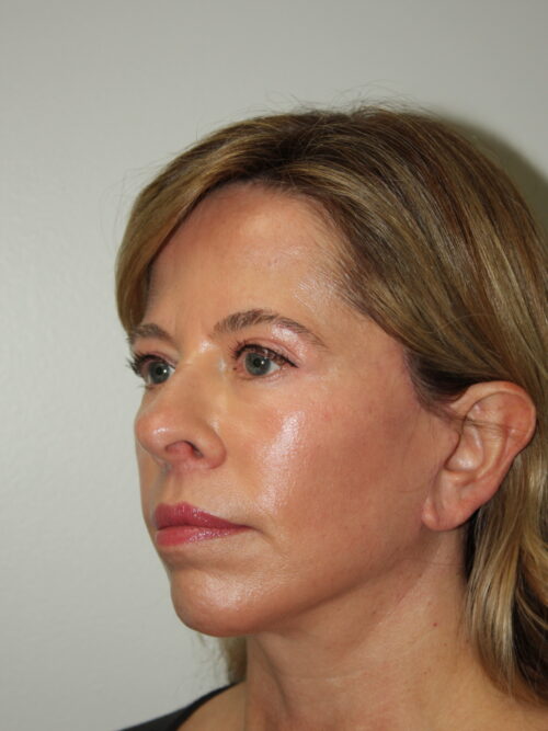 Female Facelift Patient 65 - After - 1