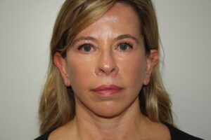 Female Facelift Patient 65 - After - 2 Thumbnail