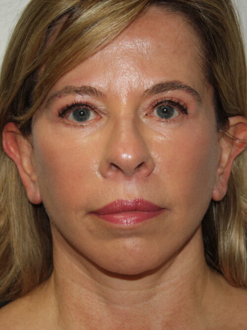 Female Facelift Patient 65 - After - 2