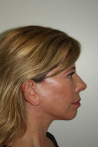 Female Facelift Patient 65 - After - 3 Thumbnail