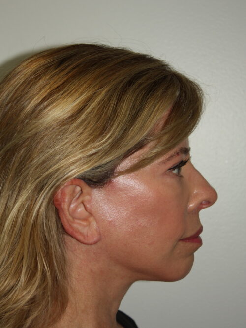 Female Facelift Patient 65 - After - 3