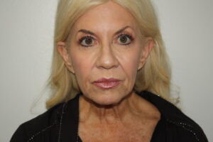 Female Facelift Patient 66 - Before - 2 Thumbnail