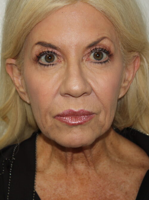 Female Facelift Patient 66 - Before - 2